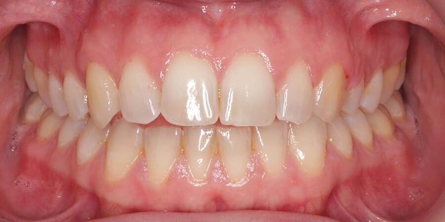 fases-ortodoncia-nivelacion